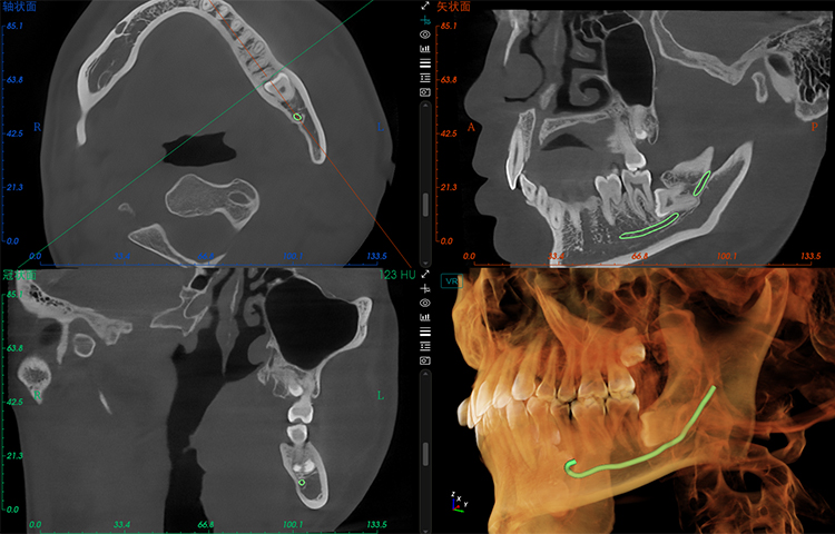 Relationship Between Wisdom Teeth, Adjacent Teeth, and the Nerve Canal