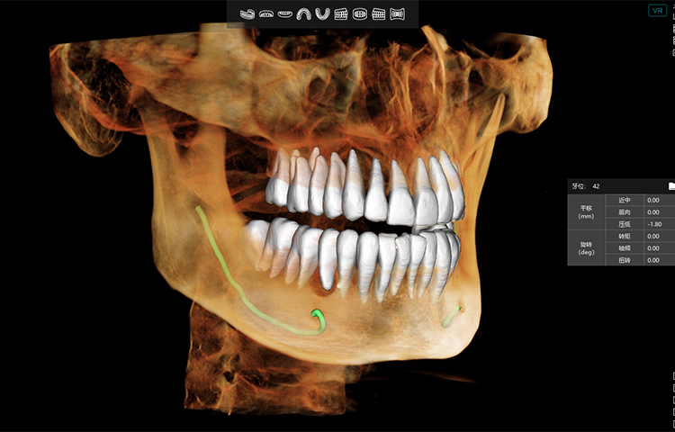 Root Resorption
