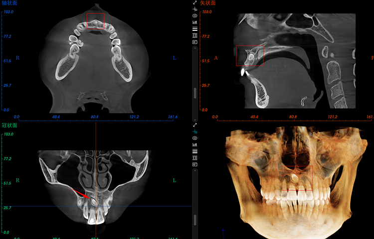 Supernumerary Teeth