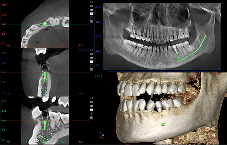 Virtual Implantation