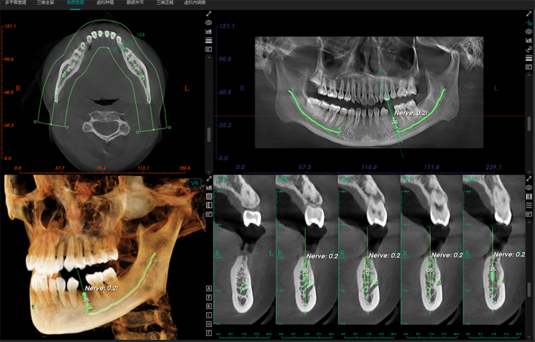 Posterior Mandibular Tooth Loss