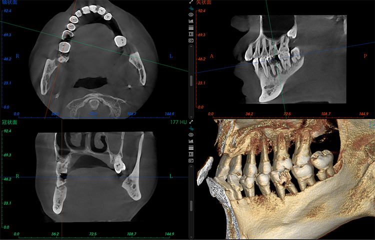 Deep Caries