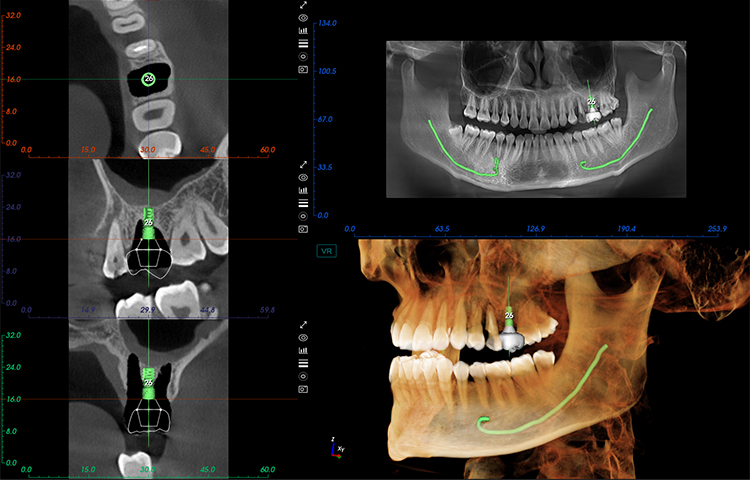 Maxillary Tooth Implants