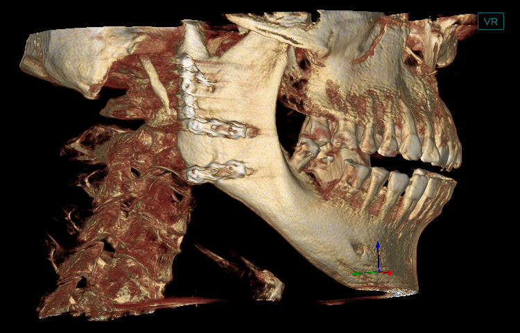 Maxillary Tuberosity Fractures Post-operation