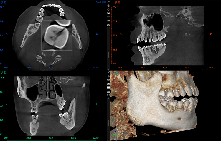 Coronal Root Fractures